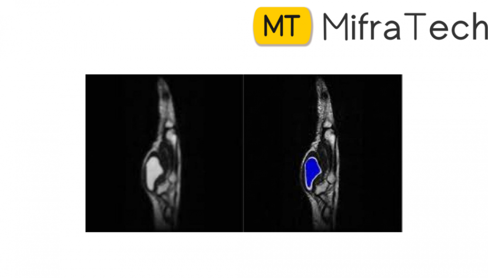 BONE TUMOUR DETECTION FROM MRI IMAGES USING IMAGE PROCESSING AND MACHINE LEARNING